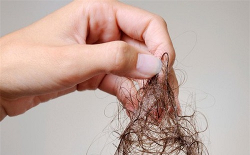 Trị rụng tóc sẽ hiệu quả hơn khi bạn nhận biết sớm được tình trạng rụng tóc